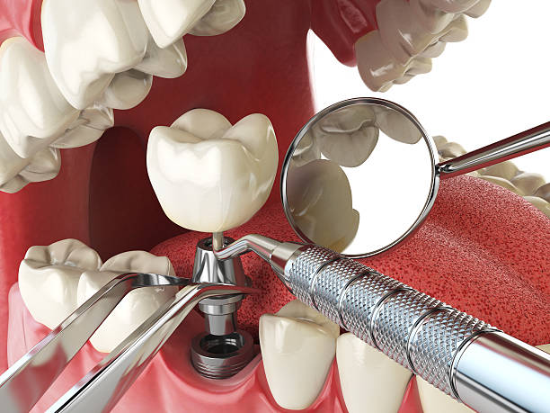Best Lost Filling or Crown Replacement in Clifton Gardens, NY